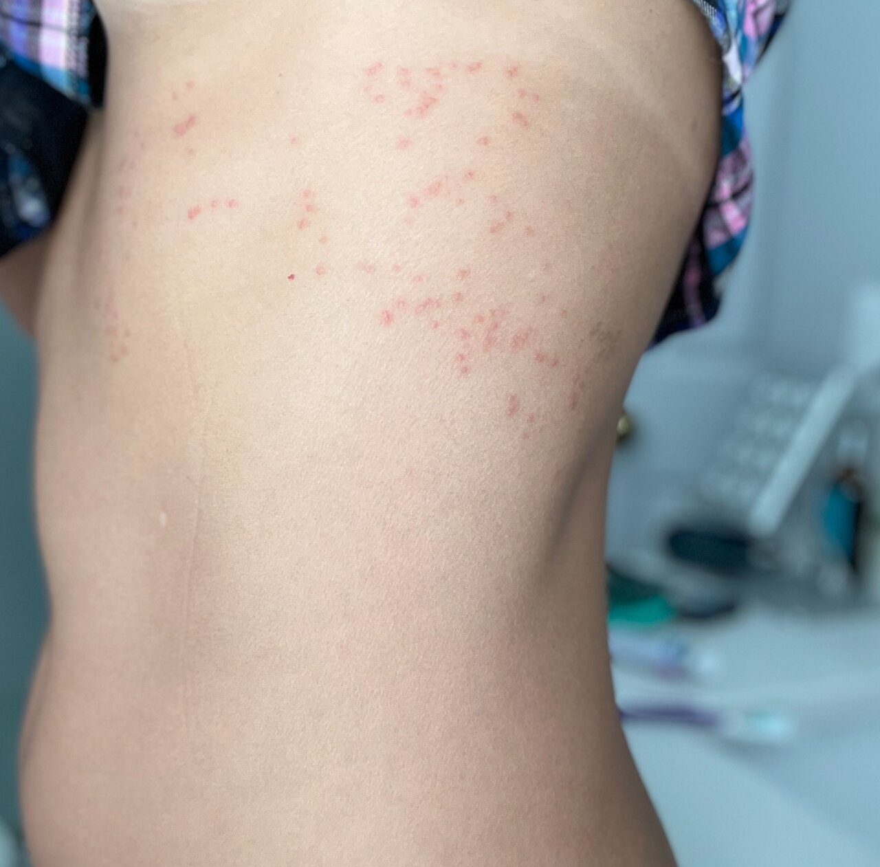 Scabies from this stay.
